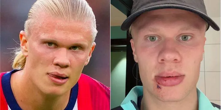 Erling Haaland avec une coupure au visage après un incident survenu à la sortie du bus de la sélection norvégienne