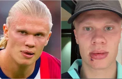 Haaland touché au visage avec la Norvège, sans conséquence sérieuse avant le match contre la Moldavie
